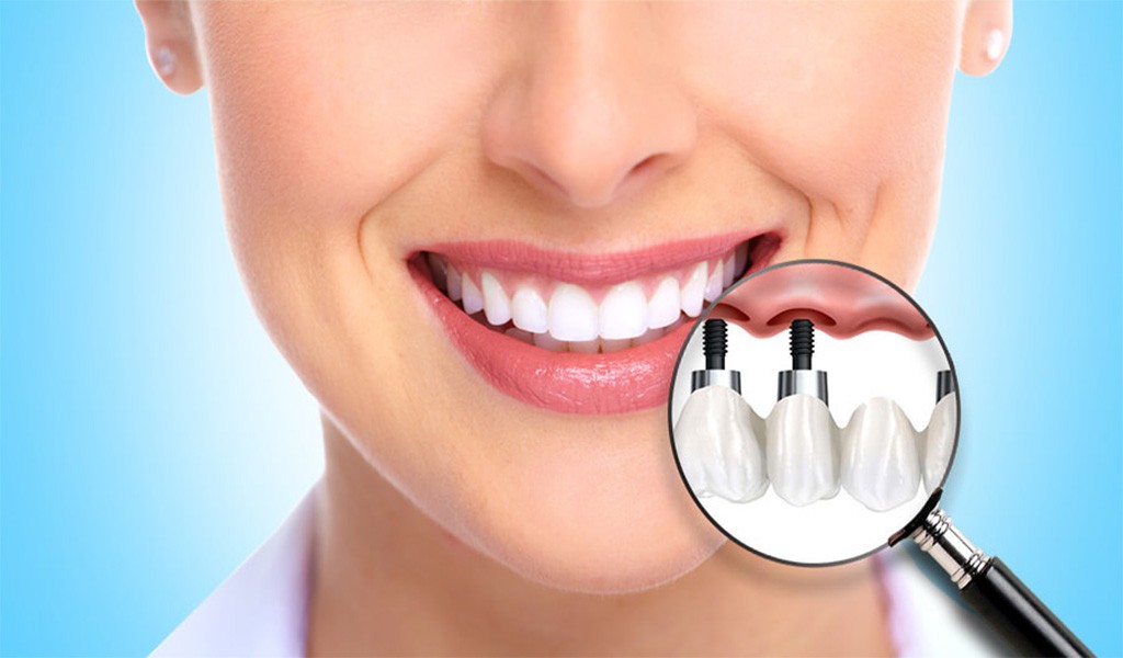Diş İmplantı (Dental İmplantlar) Nedir? Uzman Diş Hekimi Burak Kapılı